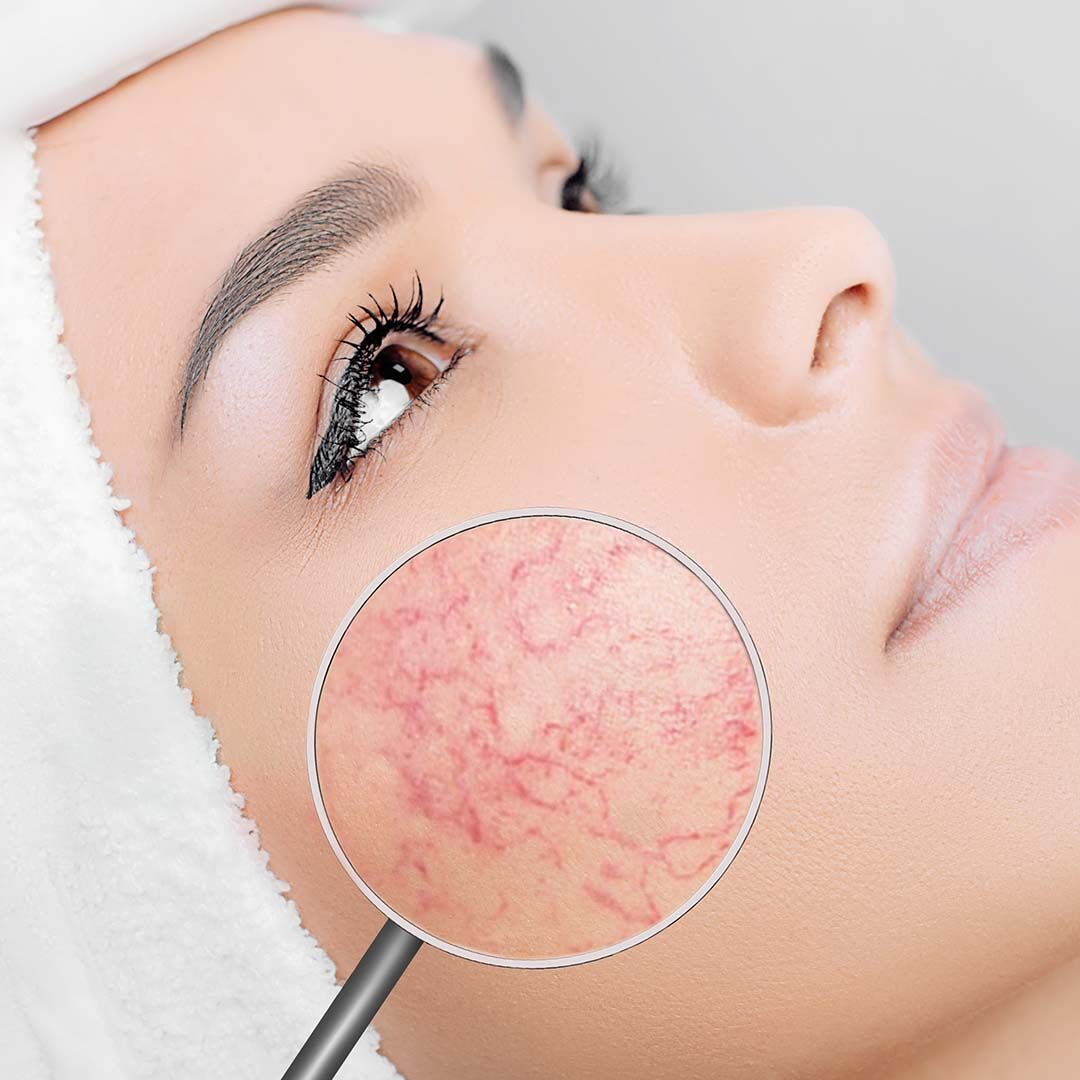 Laser V-Beam untuk Spider Veins & Rosacea