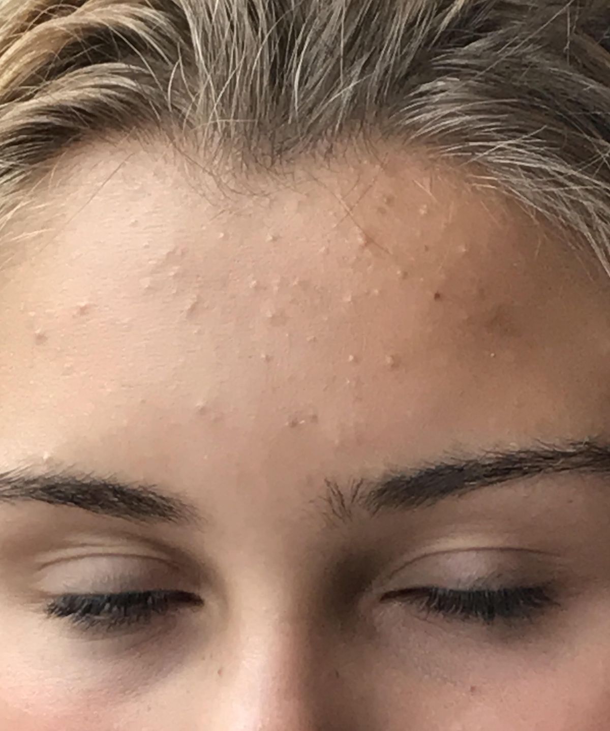 Bruntusan di Dahi Karena Skincare? Ini Faktanya