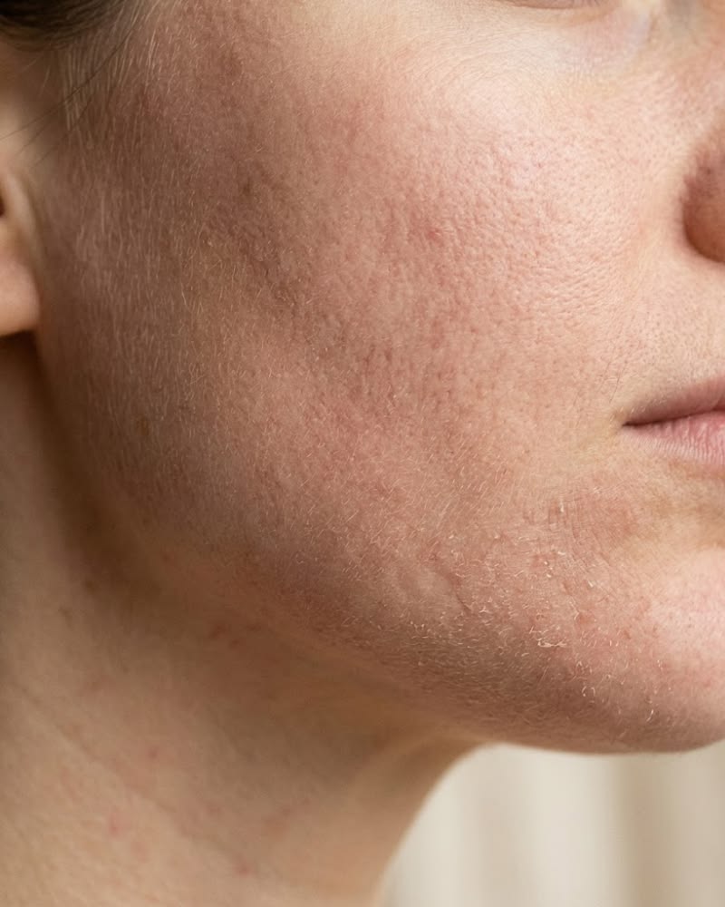 Wajah Gatal Setelah Skincare? Jangan Langsung Panik Dulu